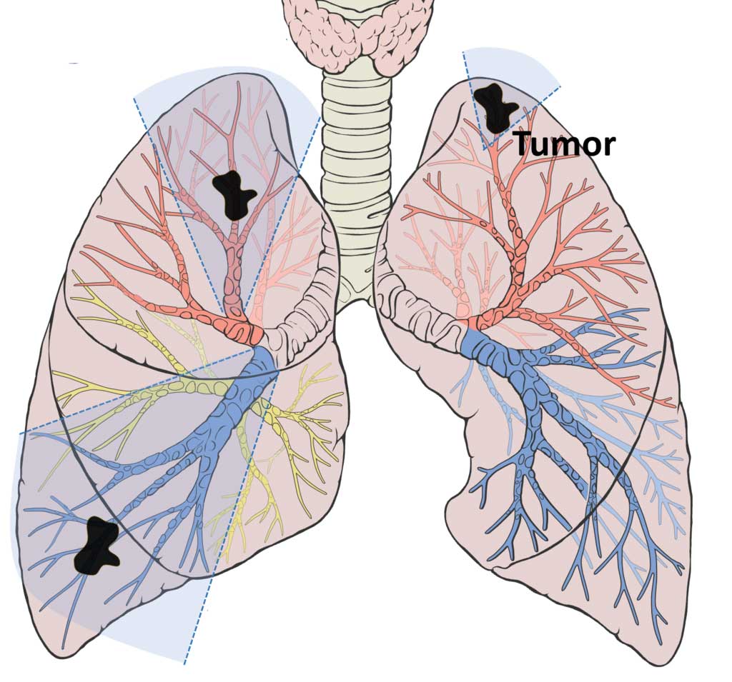 focus internazionale sul cancro del polmone