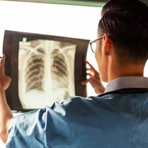 Valutazioni prognostiche cancro del polmone