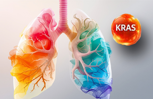 KRAS e immunoterapia tumore polmone